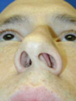 Rhinoplasty