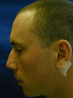 Rhinoplasty