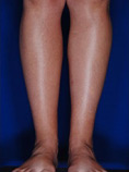 Calf Ankle Liposuction
