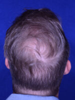 Hair Transplant