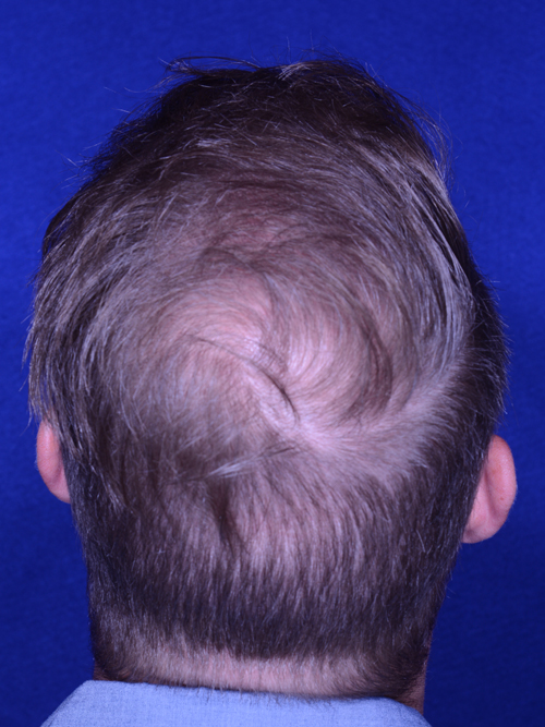 Hair Transplant