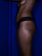 Brazilian & Fat Transfer Butt Lift