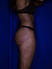 Brazilian & Fat Transfer Butt Lift