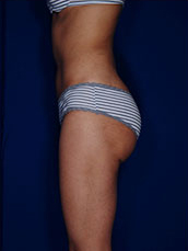 Brazilian & Fat Transfer Butt Lift