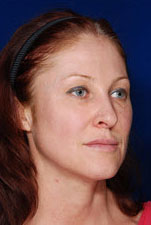 Facelift