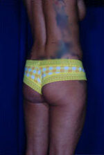 Brazilian & Fat Transfer Butt Lift
