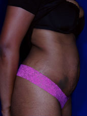Abdominoplasty