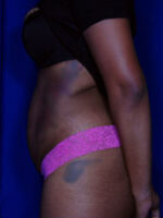 Abdominoplasty
