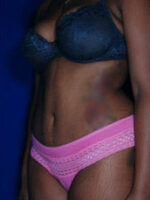 Abdominoplasty