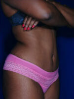 Abdominoplasty