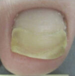 Toenail Fungus Removal