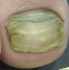 Toenail Fungus Removal