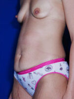 Abdominoplasty
