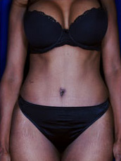 Abdominoplasty