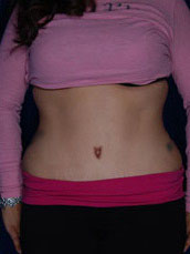 Abdominoplasty