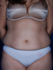 Abdominoplasty