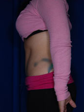 Abdominoplasty