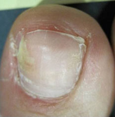 Toenail Fungus Removal