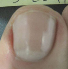 Toenail Fungus Removal