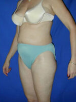 Abdominoplasty