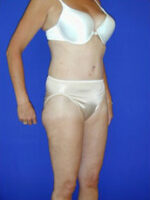 Abdominoplasty