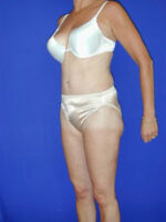Abdominoplasty