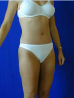 Abdominoplasty