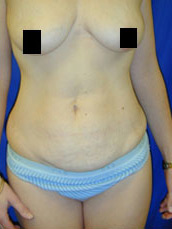 Abdominoplasty