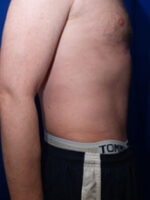 Abdominoplasty