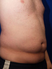 Abdominoplasty