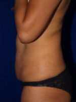 Abdominoplasty