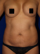 Abdominoplasty