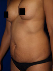 Abdominoplasty