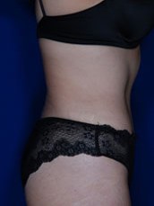 Abdominoplasty