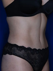 Abdominoplasty