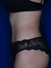 Abdominoplasty