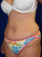 Abdominoplasty