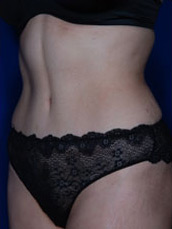 Abdominoplasty
