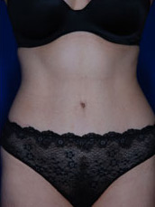 Abdominoplasty