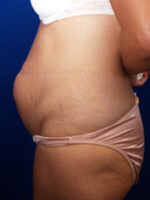 Abdominoplasty