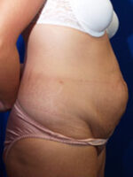 Abdominoplasty