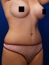 Abdominoplasty