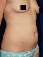 Abdominoplasty
