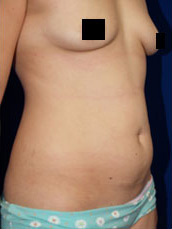 Abdominoplasty