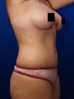 Abdominoplasty