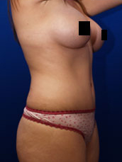 Abdominoplasty