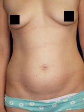 Abdominoplasty