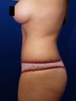 Abdominoplasty
