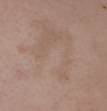 Tattoo Removal