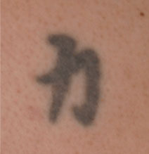 Tattoo Removal